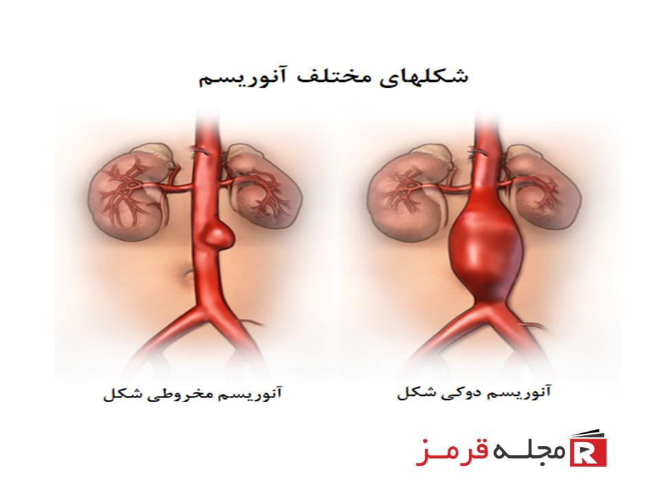 آنوریسم آئورت شکمی ؛ علتها، علائم، تشخیص و درمان آنوریسم آئورت شکمی