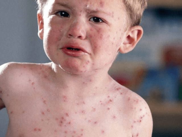 علائم ابتلا به بیماری سرخک