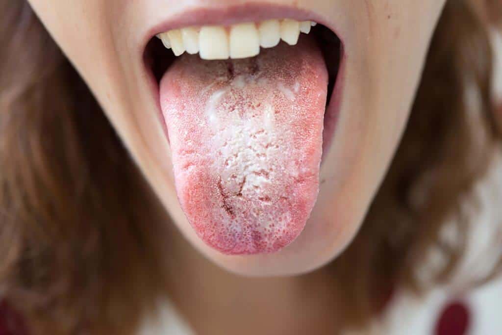 تاول لب به چه علت بوجود میآید، درمان طبی و خانگی آن چگونه است؟ برفک دهان