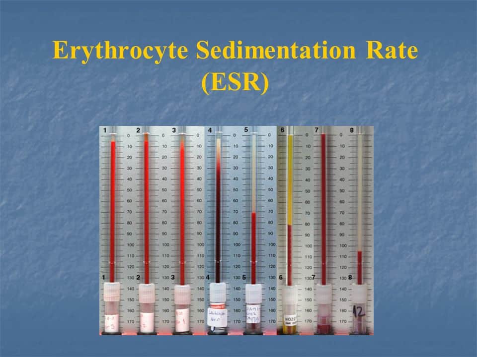 تست ESR آزمایش خون؛ نتایج نرمال و علت نتایج غیر نرمال تست ESR آزمایش خون