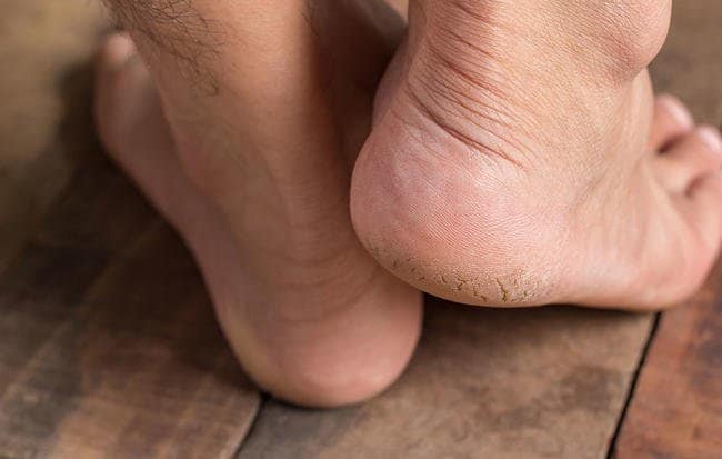 خواص روغن آرگان برای سلامتی بدن و زیبایی پوست و مو ترک پاشنه پا
