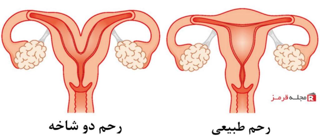 رحم دو شاخه یا قلبی شکل (رحم دو قطبی): تشخیص و درمان رحم دو شاخه