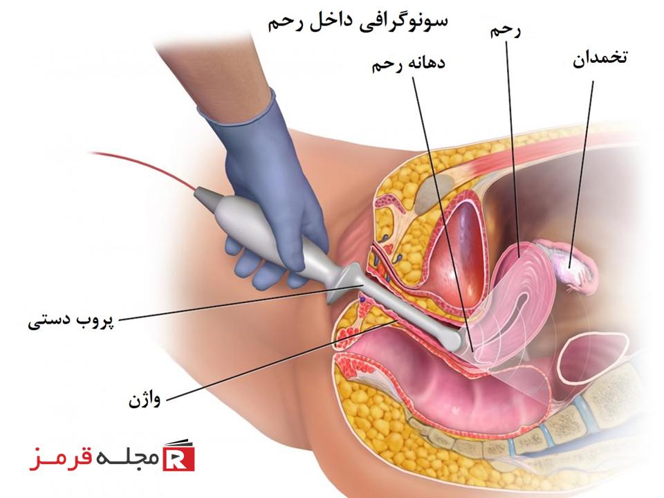 سونوگرافی (ultrasound)؛ انواع کاربردها و آمادگی قبل از آن چیست؟ سونوگرافی داخل رحم